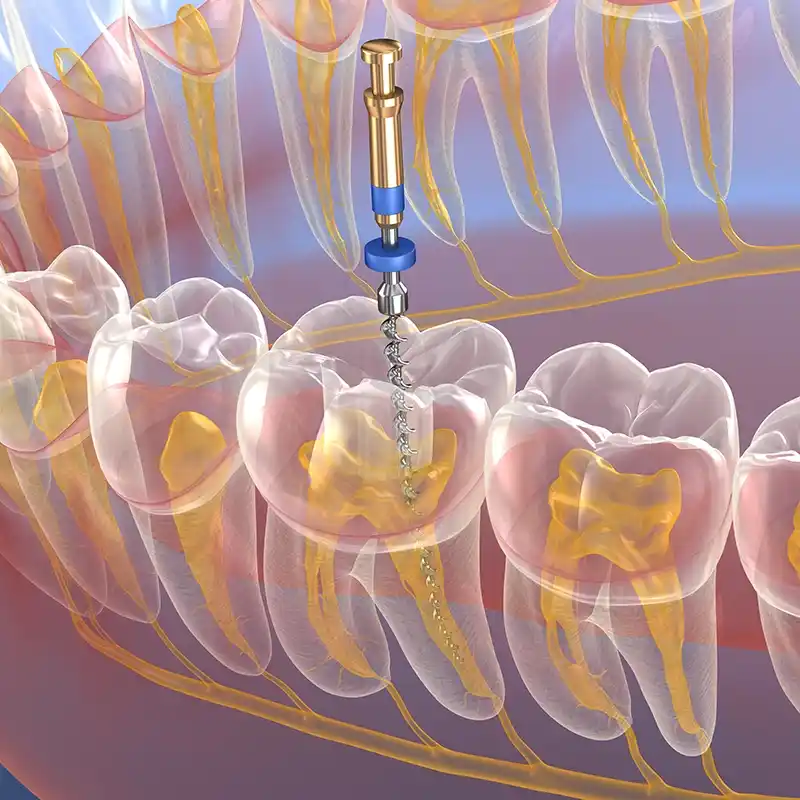 Render de una endodoncia.