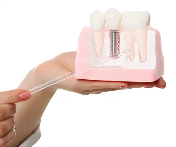 Maqueta de un implante dental.