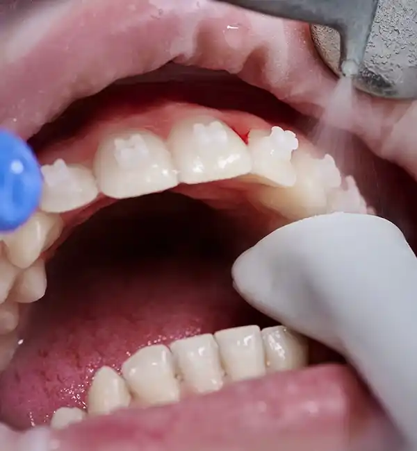 Limpieza dental de una paciente que tiene brackets..