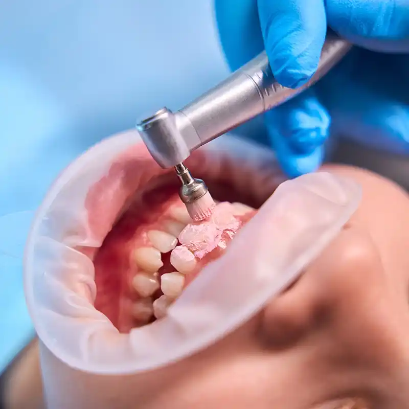 Paciente haciéndose una limpieza dental en la consulta.