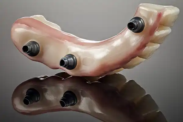 Prótesis dental fija.