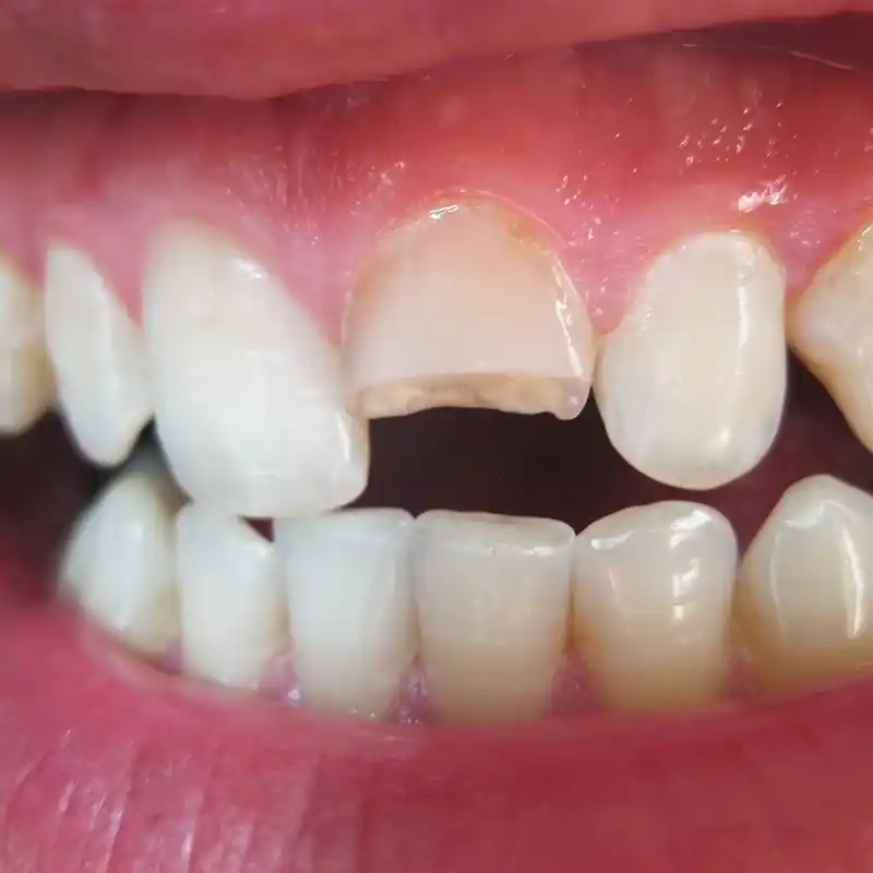 Diente roto antes de una reconstrucción dental.